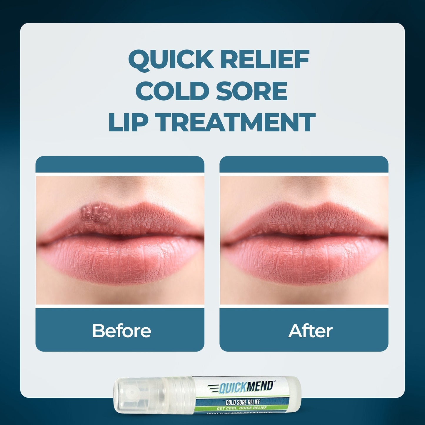 QuickMend Cold Sore Relief Lip Treatment – Pump Dispenser (4.5 ml)